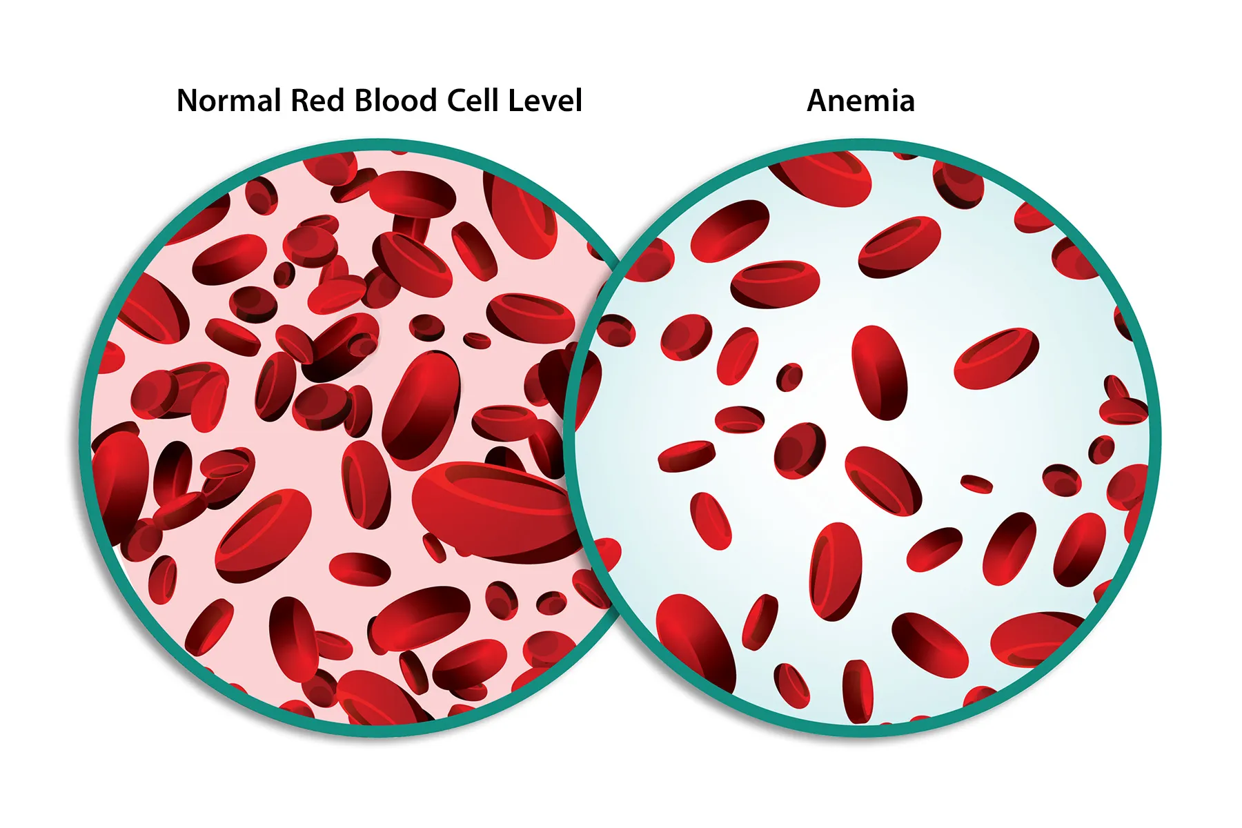 Anemia