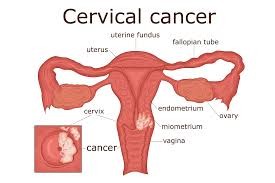 Cervical Cancer