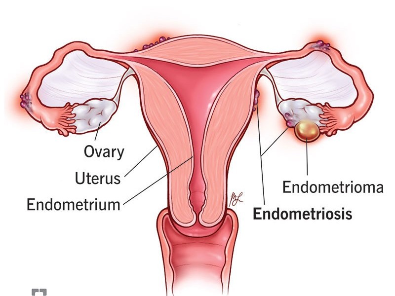 Endometriosis