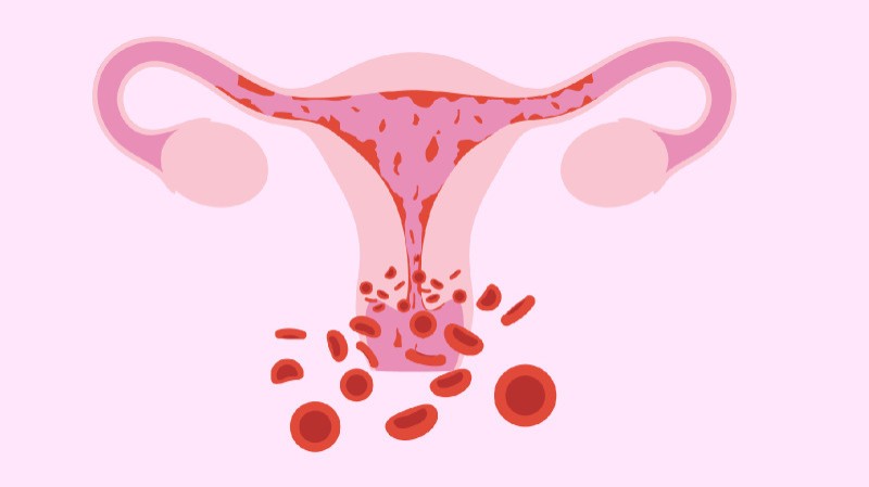 Menorrhagia